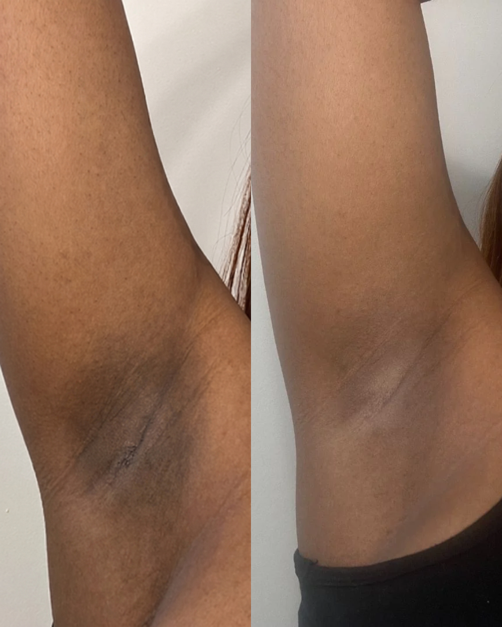 Dark underarm before and after result